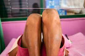 Image result for Functional Leg Length Discrepancy