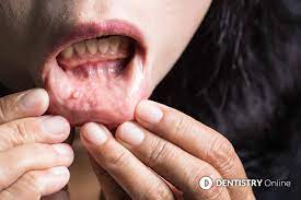Numbness in the mouth, neck or face that you are unable to explain 2. Mouth Cancer Reported Spike After Dental Access Issues Dentistry Co Uk