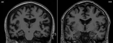 Lewy body dementia (lbd) is one common cause of dementia. Clinical Imaging In Dementia With Lewy Bodies Evidence Based Mental Health