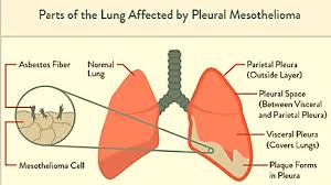 The cause of pleural mesothelioma is exposure to asbestos fibers, which a person can inhale into the lungs. Pleural Mesothelioma Wikitechy