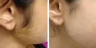 A survey by the american laser centers showed that women spend more than $10,000 on shaving products over their lifetime. Laser Treatment For Eyebrows Cost In India Eyebrowshaper