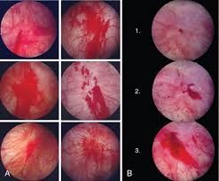 Image result for Interstitial Cystitis