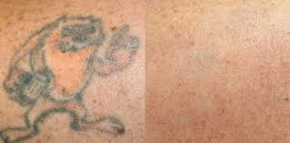 Medicetics are pioneering a new technique from the usa to use alongside lasers that allow multiple treatments per visit. Open Canvas Tattoo Removal Uses Lasers To Fade Away Ink And More Strokes Plugs San Luis Obispo New Times San Luis Obispo