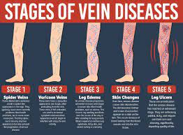 Treatment of varicose and telangiectatic leg veins: Varicose Veins Cream Removal Varicose Veins Treatment Anti Foot Leg Va 1stavenue