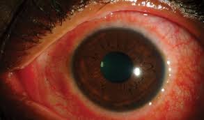 Image result for lesion sclera