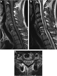 Image result for Spinal Trauma