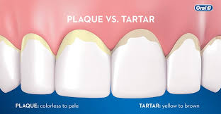 Plaque is a sticky film of bacteria that constantly forms on teeth. Tooth Plaque And Dental Tartar Oral B