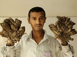 Tree man is a genetic disorder in which strange warts appear all over body. Riesige Warzen Finger Baum Mann Aus Bangladesch Wieder Im Krankenhaus Gesundheit