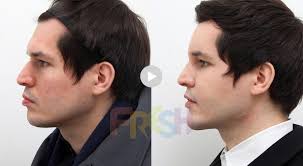 Jul 01, 2021 · but the latest one to hit the market, restylane contour, touts some unique and noteworthy differences. Facial Fat Grafting Nose Filler Chin Filler Forehead And Eye Brow Botox Korean Plastic Surgery Brazilian Butt Lift Fresh Plastic Surgery