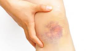 We did not find results for: Leucemia Mieloide Cronica Poco Prevenible Pero De Buen Pronostico Si Se Diagnostica A Tiempo