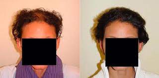 Wenn bei frauen in noch behaarte flächen verdichtet wird, können durch den stress der haartransplantation, der betäubung etc. Haartransplantation Frauen So Funktioniert S Hairforlife