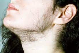 Androgenic alopecia, or male pattern baldness, is associated with an imbalance of male hormones (androgens), specifically dihydrotestosterone (dht). Hirsutism You And Your Hormones From The Society For Endocrinology