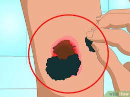 4 Ways To Get Rid Of Acne Scabs Fast - Wikihow