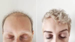 Options include detachable bangs, human hair fringe, partial hairpieces that attach to a headband, and many others. Please Stop Complimenting My Post Chemotherapy Hair Allure