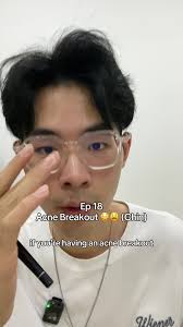 Clarithromycin for Acne Review