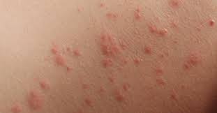 Image result for contact dermatitis
