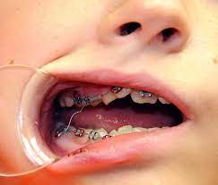 If the wire is painful, you can try cutting it with nail clippers or scissors that have been washed and sterilized in alcohol. My Wire Came Loose And Is Poking What Do I Do Ask An Orthodontist Com