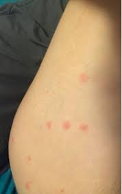 Non Baby Question But Flea Bites June 2018 Babies Forums What To Expect