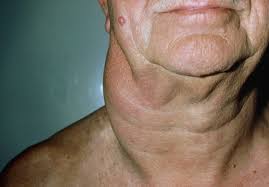 8 in the united states, lung cancer has the highest mortality of all cancers, and disease spread to the scalene lymph nodes (n3) may contraindicate surgical therapy. Lymphadenopathy Cardiovascular Disorders Msd Manual Professional Edition