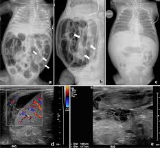 Image result for Necrotizing Enterocolitis