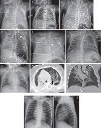 Treatment of breathing problems in premature babies. Pulmonary Hemorrhage In Neonatal Respiratory Distress Syndrome Radiographic Evolution Course Complications And Long Term Clinical Outcomes Ios Press