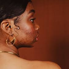 What are recommendations for stress acne?