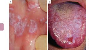 Image result for lichen planus on tongue)
