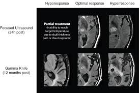 Image result for Thalamotomy