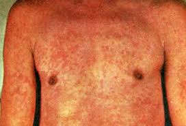 Image result for sweat rash on back