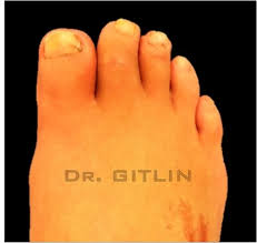 Image result for Syndactyly