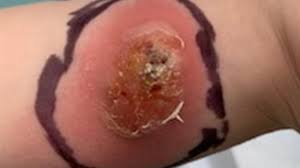 Image result for spinne biss haut reaktion