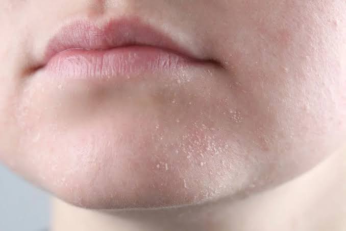 Bà Bầu Bị Khô Da Mặt: Nguyên Nhân Và Cách Chăm Sóc Hiệu Quả Tại Nhà