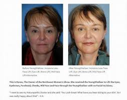 Youngvitalizer Breakthrough Incision Less Face Lift Review Testimonial Seattle Bellevue Dr Philip Yo Facial Plastic Facial Plastic Surgery Plastic Surgery