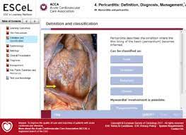 .circulating cardiac autoantibodies in dilated cardiomyopathy and myocarditis: Myocarditis Pericarditis Module