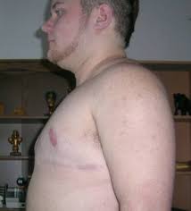 Mastektomie am 08.03.2005