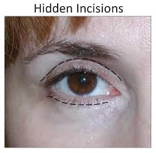 Risks associated with surgery in general, including reaction to anesthesia and blood clots talk to your doctor about how surgical risks apply to you. Blepharoplasty Dr Moustafa Mourad Nyc Plastic Surgeon