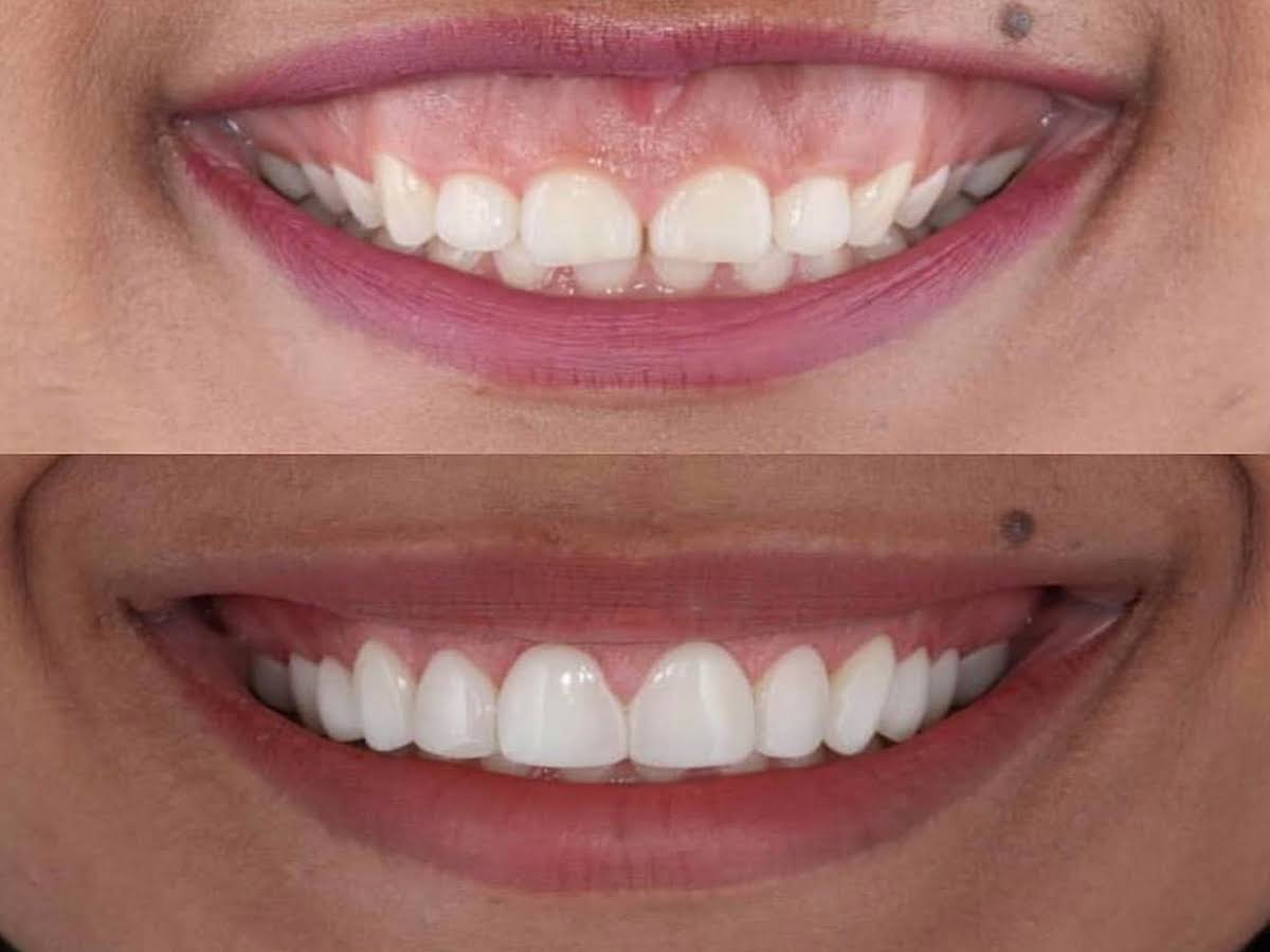 Gummy smile correction product image