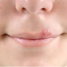 How do cold sores spread? My Son Keeps Getting Cold Sores How Can I Help To Prevent Them Montreal Children S Hospital