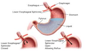 Heartburn Reflux And Gerd 10 Nutrition And Lifestyle Tips