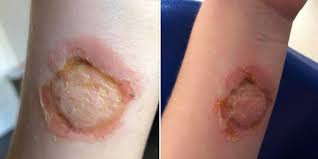 Image result for spinne biss haut reaktion