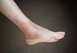 10 Signs Symptoms Of Gout Gout Symptoms Signs Gout Symptoms Signs And Symptoms
