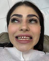 GOSSIP DO GAME on X: VEJA: Influenciadora Bruna Duarte mostra como ficaram  seus dentes após aplicação de lentes de contato. Ela está iniciando um novo  tratamento com uma clínica especializada. t.coZbUNg67kUk 