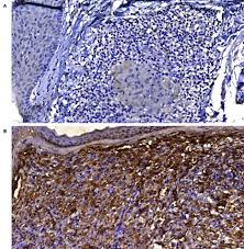 What is the life cycle of leprosy? Scielo Brasil Expression Of Nlrp3 Inflammasome In Leprosy Indicates Immune Evasion Of I Mycobacterium Leprae I Expression Of Nlrp3 Inflammasome In Leprosy Indicates Immune Evasion Of I Mycobacterium Leprae I