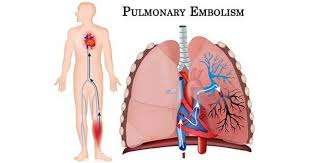 Sebagai orang melayu, mesti anda sudah biasa terdengar berkenaan dengan tempoh berpantang selepas bersalin kan? Kadar Kematian Ibu Melayu Disebabkan Pulmonary Embolism Paling Tinggi