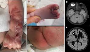 Image result for Protein C Deficiency