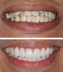 A person considering cosmetic dental work should discuss their options with a dentist. Types Of Dental Veneers Harley Street Smile Clinic