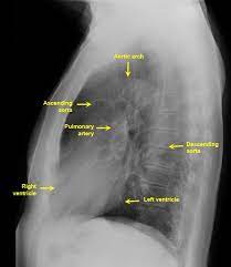 Structure and function of the shoulder complex. Lateral Chest Radiograph Anatomy Normal Lateral Chest X Ray Male Plain X Ray Chest And Abdomen Radiology Student Radiology Radiology Imaging