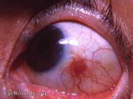 Image result for lesion sclera