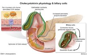 Image result for Biliary Colic