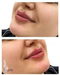 فيلر ذقن وشفاه💉 تناسق وجمال وجاذبية ❤️❤️ للاستفسار والمواعيد بالامارات  للتواصل اتصال او واتس على الرقم 👇🏻 📱+971 52 346 5551 #dermatology  #laserhairremoval #filler #botoxinjections #mesotherapy #dermapenfacial  #hifo #fractionallaser #damascus ...